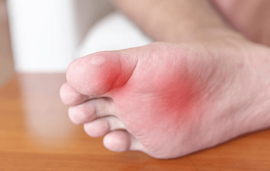 Athlete's Foot & Fungal Infections