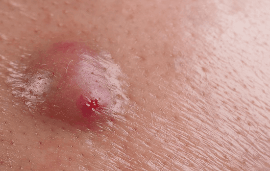 Wart & Skin Tag Removal